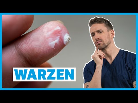 Warzen verstehen: Ursachen, Symptome, Diagnose & Therapie | DocTommy