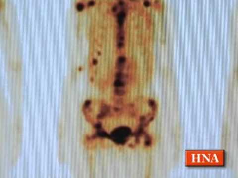 Bandscheibenbruch Halswirbelsäule Behandlung Volksmedizin Anatomische Zone zur Behandlung von Rückenschmerzen
