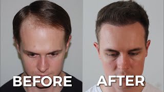 Hair Transplant Before and After