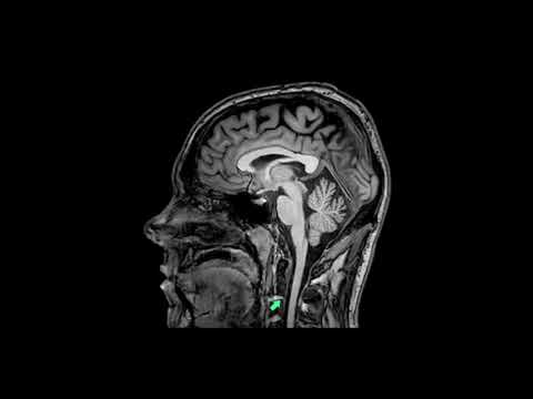 Brain and midline anatomy