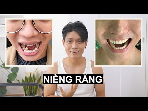 Niềng răng và những sự thật ai cũng nói dối bạn