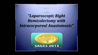 Download Lagu Intracorporeal anastomosis: right and left colon Thumbnail