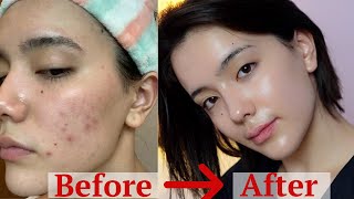 how I got rid of my ACNE after 8 years - ONLY thing worked