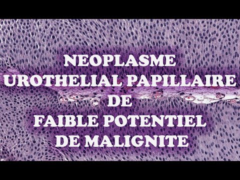 LE NEOPLASME PAPILLAIRE UROTHELIAL DE FAIBLE POTENTIEL DE MALIGNITE - PATHOLOGIE