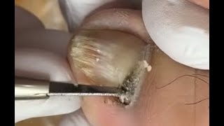 How to repair nails