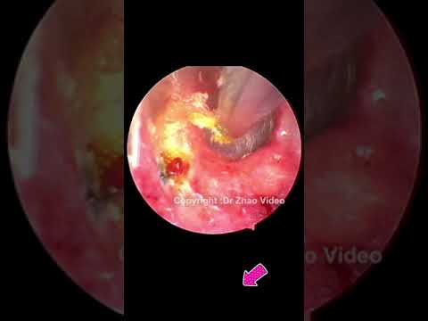 EAR WAX REMOVAL #Shorts #700