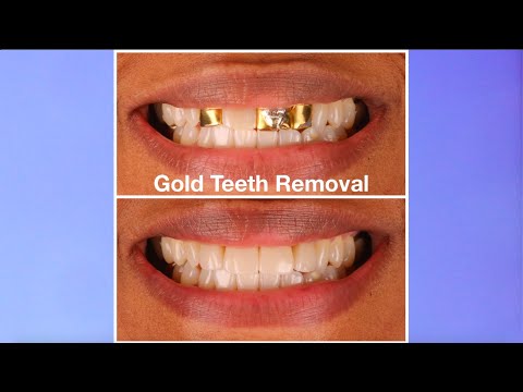 Changing out GOLD TEETH for PORCELAIN VENEERS!
