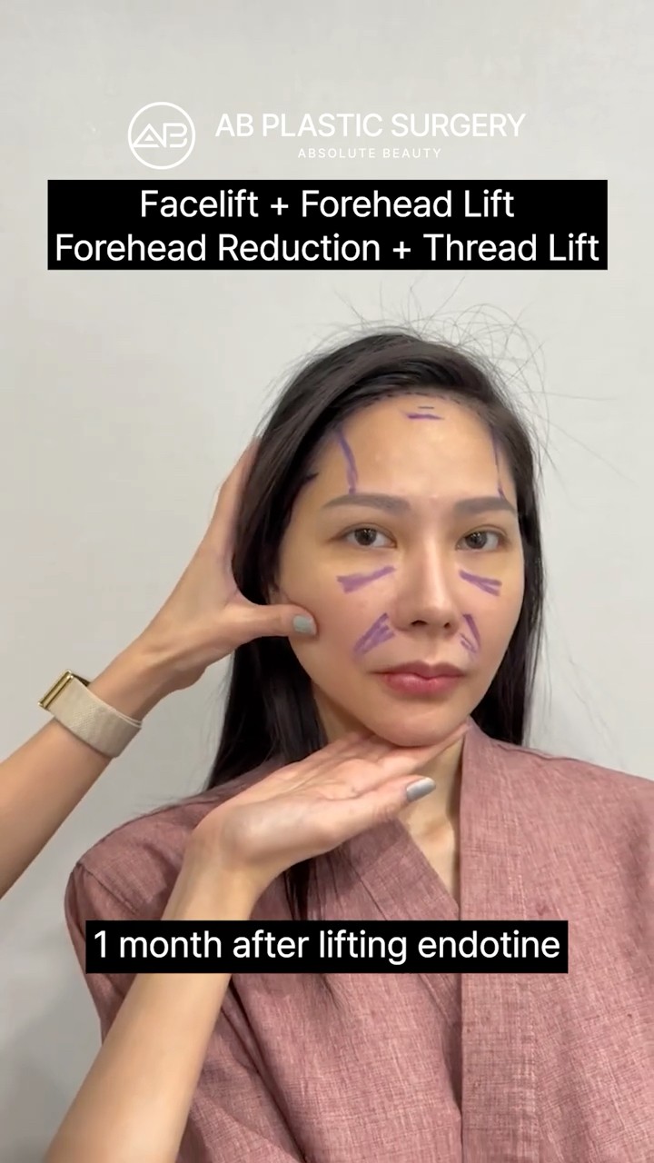 Korean Facelift Made My Face Tiny
