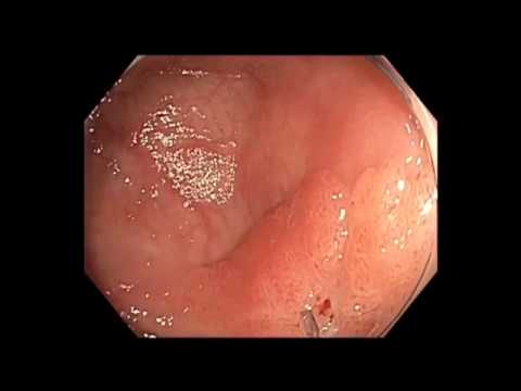 Colonoscopy: Cecal Recurrent Lesion in the Midst of Another Cancer