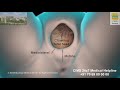 Episiotomy CIMS Hospital