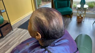 She is losing her hair and color fading into gray | Alopecia Transformation