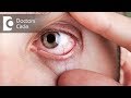 What causes visible red fine lines in eyes? - Dr. Elankumaran P