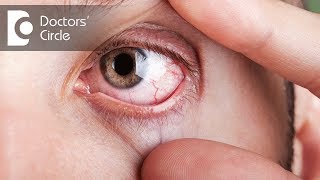 What causes visible red fine lines in eyes? - Dr. Elankumaran P