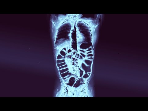 A Student Drank 2 Liters Fiber Supplement For Dinner. This Is What Happened To His Intestines.