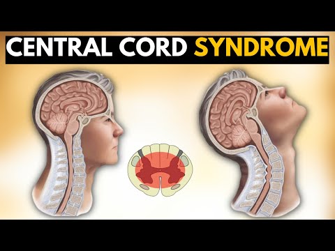 Brain Aneurysm Causes Signs and Symptoms Diagnosis and Treatment