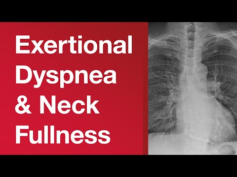 Middle-aged Man With Exertional Dyspnea and Neck Fullness