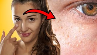 How To Get Rid of Little Bumps on the Face - Milia Removal at Home