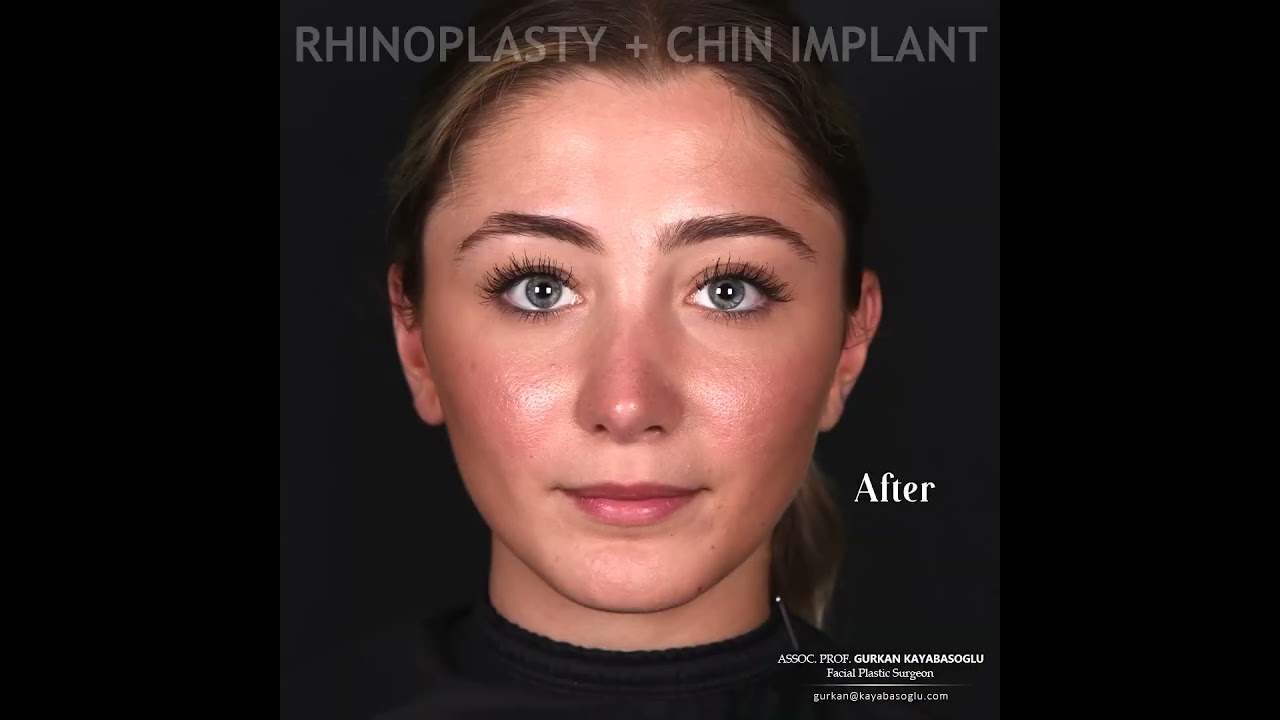 Dr Gurkan Kayabasouglu Plastic Surgeon in Istanbul, Turkey- Rhinoplasty & Chin Implant