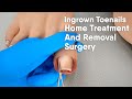 Ingrown Toenail Home Treatment And Removal Surgery 3d Animation