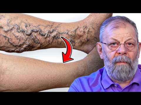 ПОКАЗЫВАЮ КАК БЫСТРО ВЫЛЕЧИТЬ ВАРИКОЗ БЕЗ ОПЕРАЦИИ 1 УПРАЖНЕНИЕМ