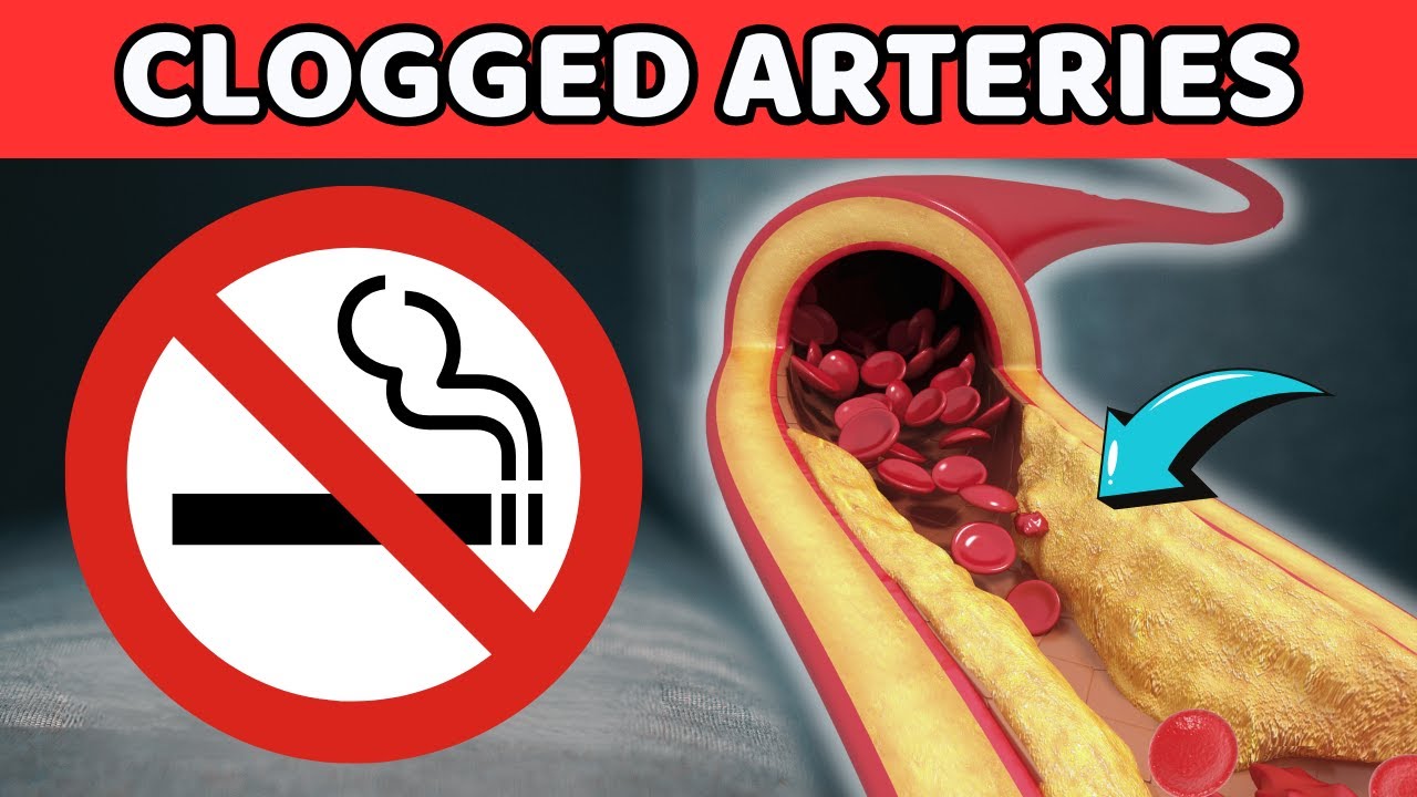 Doing These 5 Things EXCESSIVELY Will PERMANENTLY Clog Arteries | Vitality Solutions 
