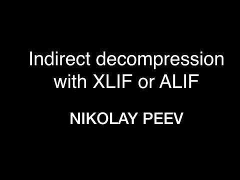 Nikolay Peev  Indirect decompression with XLIF or ALIF