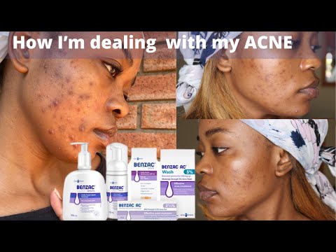 Benzoyl Peroxide (Benzac AC) for ACNE: 3 weeks update || My experience || South African Youtuber