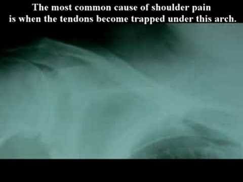 What is Rotator Cuff? What is shoulder injury?