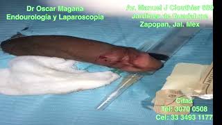 Dr Oscar Magaña @urologozmg - Frenulectomia o Frenuloplastia con Fulguracion de VPH