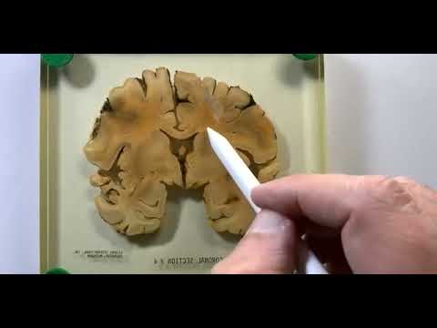 Sectional Anatomy of the Brain  - Coronal Sections