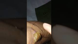 removing scabs