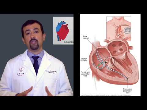 What Is an AV Node Ablation?