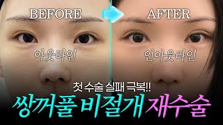 [ENG/CN/JPN SUB] 🔥비절개 쌍꺼풀+앞트임🔥상담부터 수술경과까지 모두 보여드립니다!
