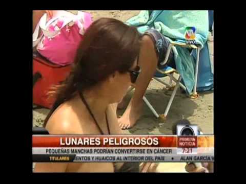 Un inofensivo lunar puede producir cancer de piel – Descarte con Dermatoscopio