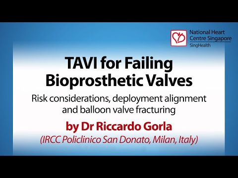 TAVI for Failing Bioprosthetic Valves - SingValve Lecture June 2022