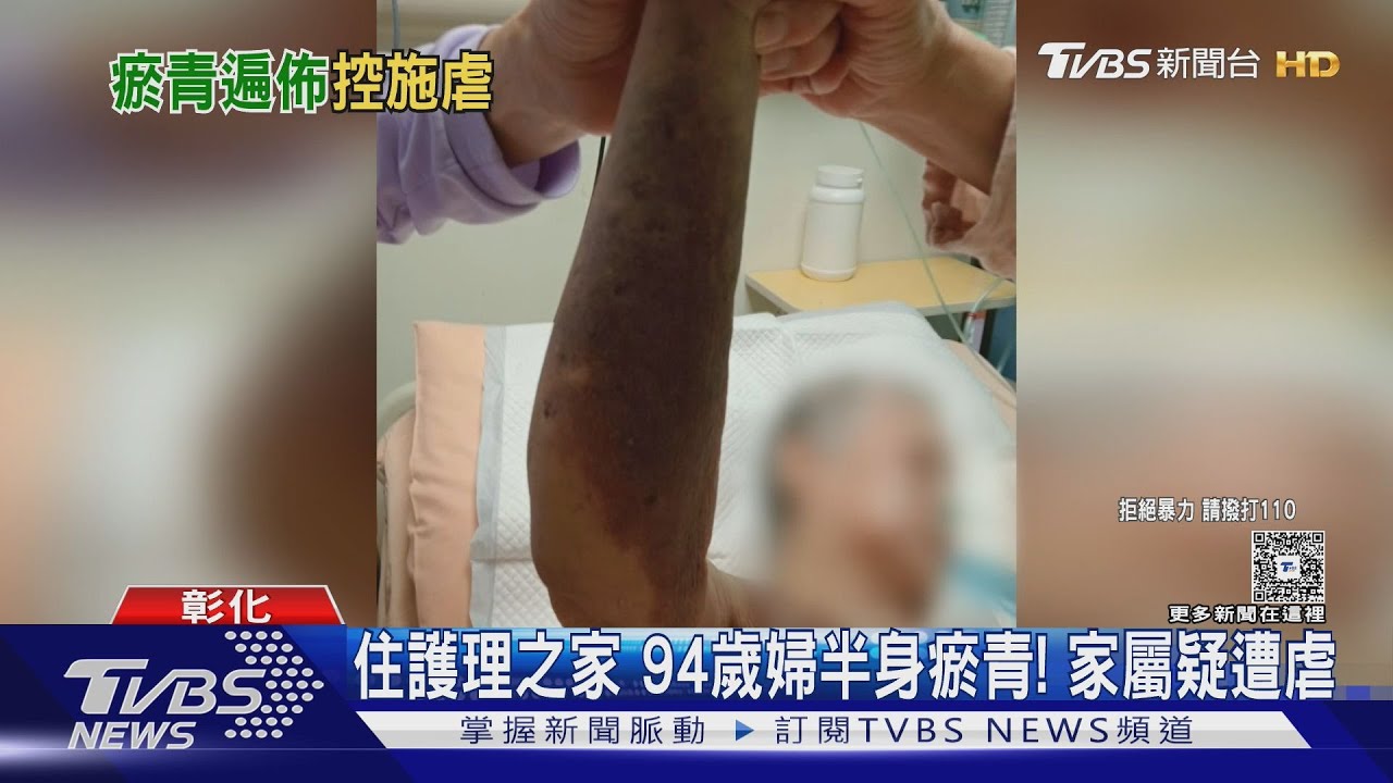 驚見母親全身是傷!94歲失智婦「右側大面積瘀青」家屬心碎