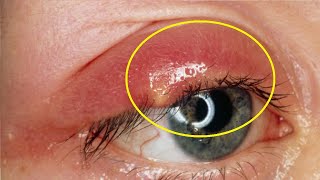 how to get rid of a chalazion with apple cider vinegar