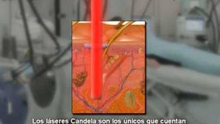 Depilación Láser en Ibiza (Baleares)