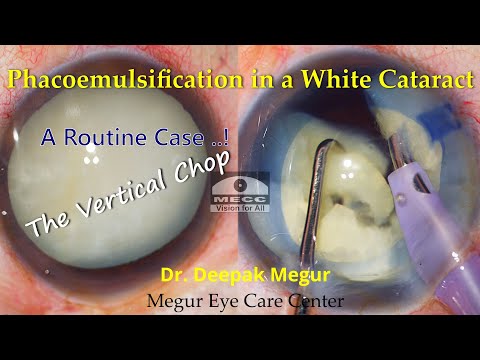 Phacoemulsification in mature cataract Routine Case - Dr Deepak Megur