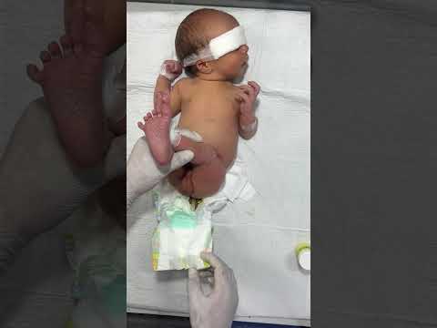 *"Suppository Use in Neonates | Rectal Medication Administration in Newborns"*