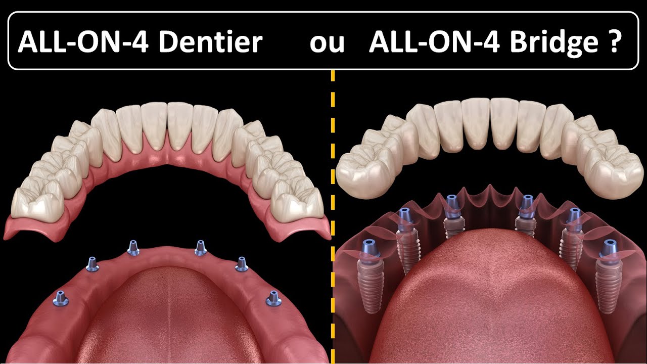 All on 4 - Type de prothèse :  Dentier ou Bridge 
