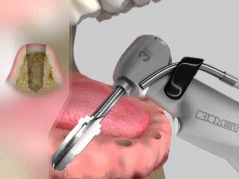 Praxis Dr. Erhard - Zahnloser Kiefer