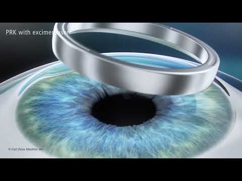 PRK Treatment Animation