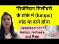 सिजेरियन डिलीवरी के टांके में गांठ और 