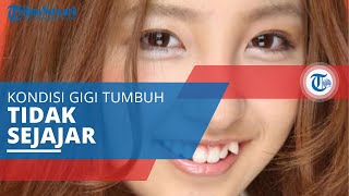 Gigi Gingsul, Kondisi di Mana Gigi Tidak Tumbuh pada Tempat yang Benar dan Sejajar