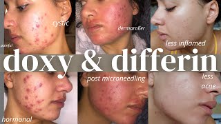 How to get clear skin with Doxy and differin *with results* | how I cleared my skin in 3 months