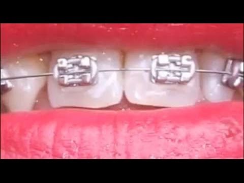 Verschiedene Zahnspangen - Kieferorthopädie