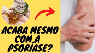 Copavita é Bom Mesmo? Óleo de Copaíba Acaba Com a Psoríase?