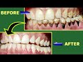 Tambaku Ke Dant Kaise Saaf Karen Teeth Tobacco Stain Removal Shorts