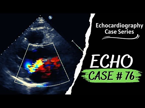ECHO CASE 76 | Echocardiography spot diagnosis Series | Echocardiogram Interpretation